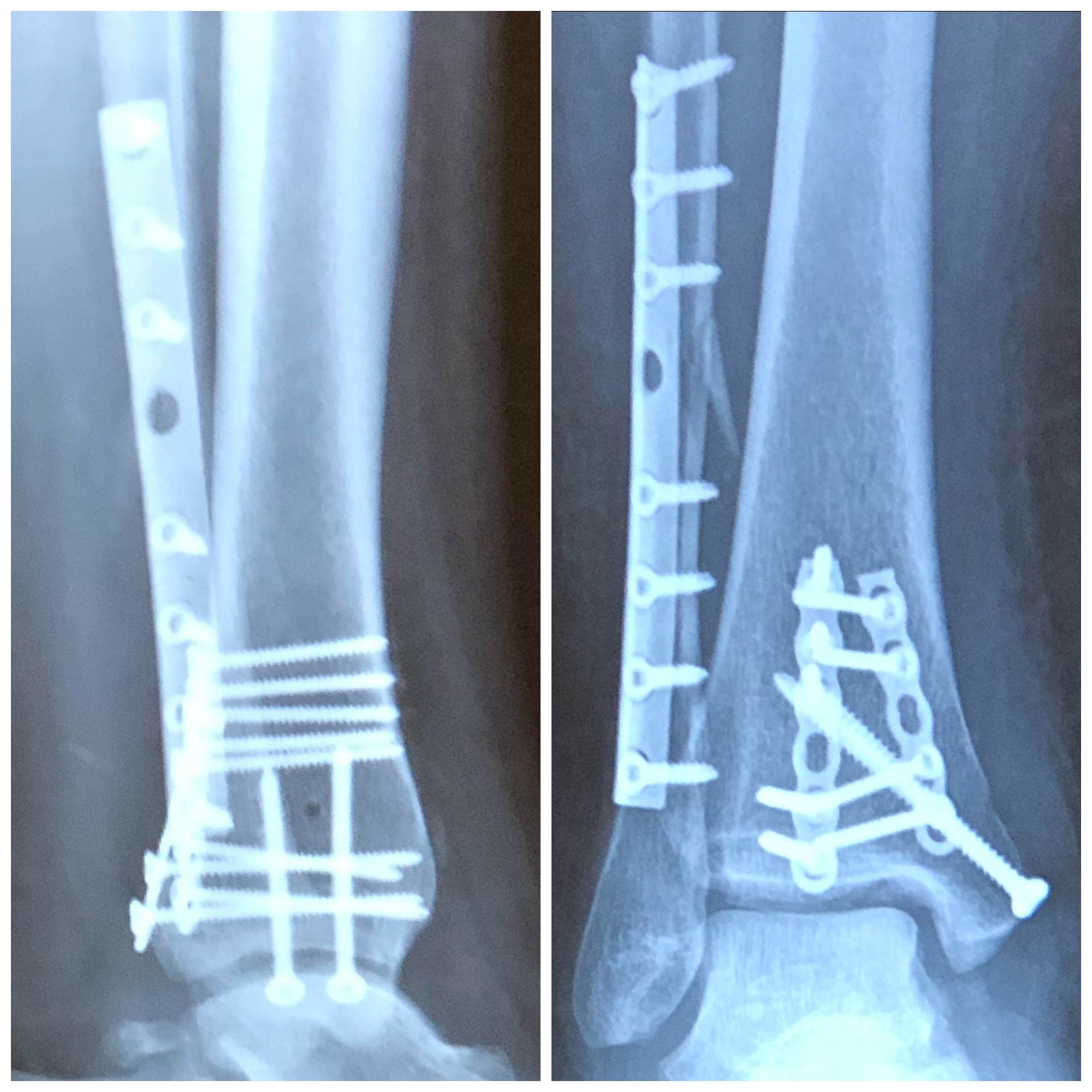 trimalleolar fracture surgery