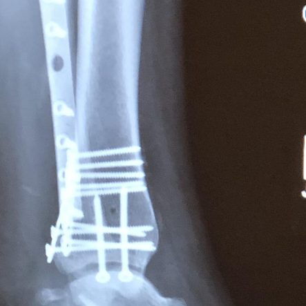 Broken Ankle Surgery Recovery After Trimalleolar Fracture